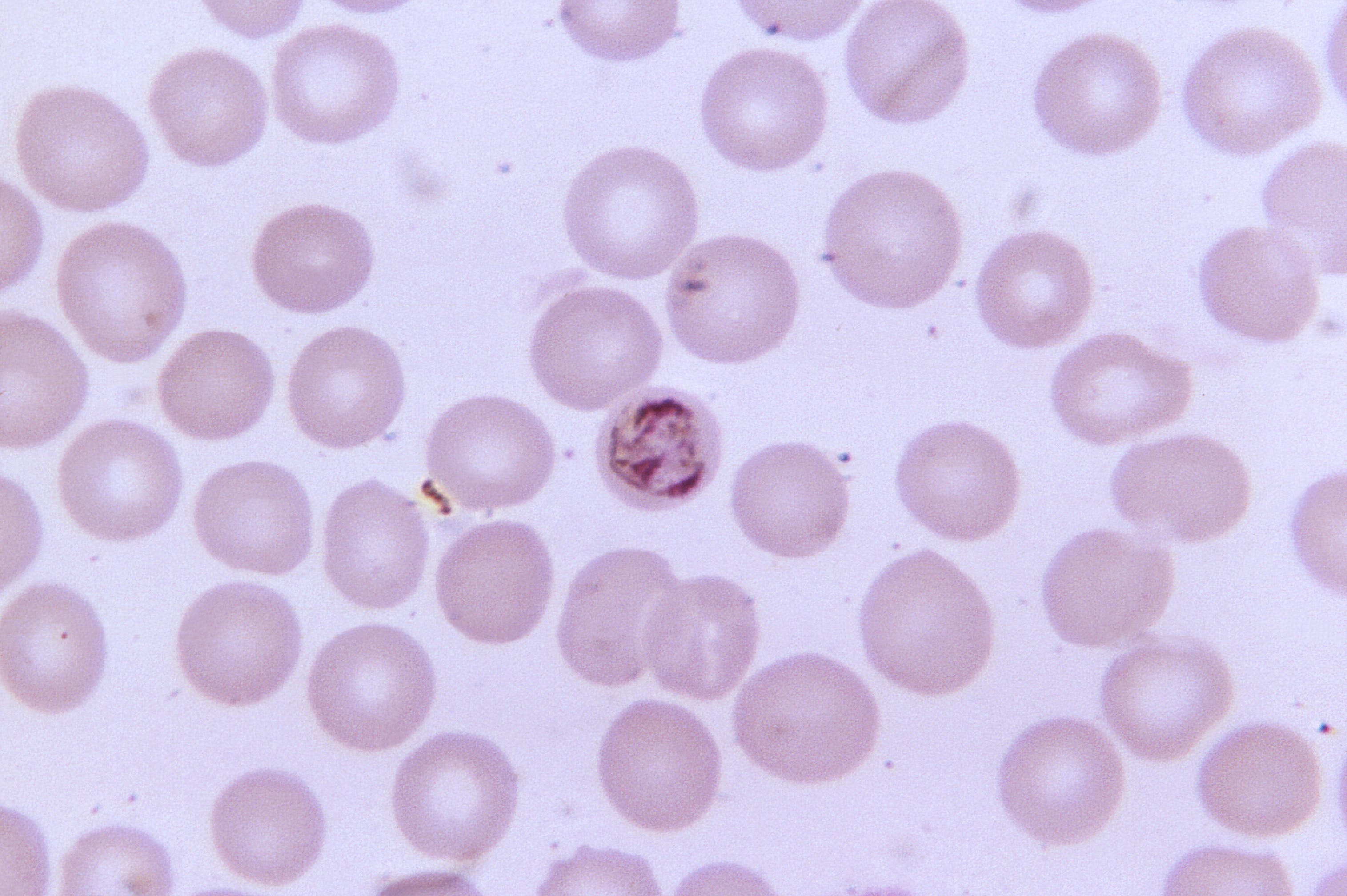This thin film blood smear photomicrograph depicts an immature, Plasmodium malariae schizont, which contains three chromatin masses, a light cytoplasm, and a dark pigment.