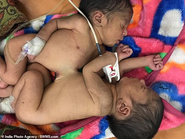 Cirurgiões separam gêmeos siameses de três dias